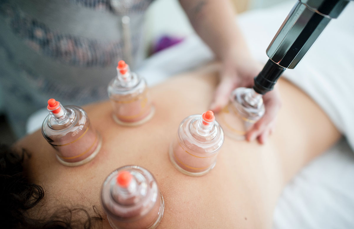 Cupping Therapy in Aylesbury