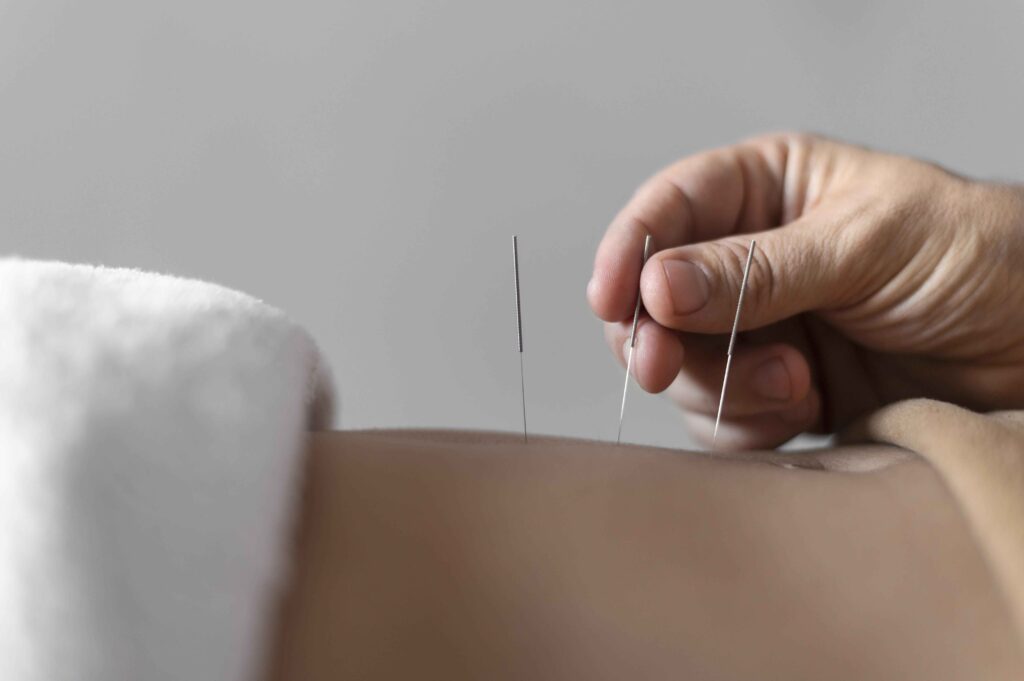 Acupuncture treatment in Wendover