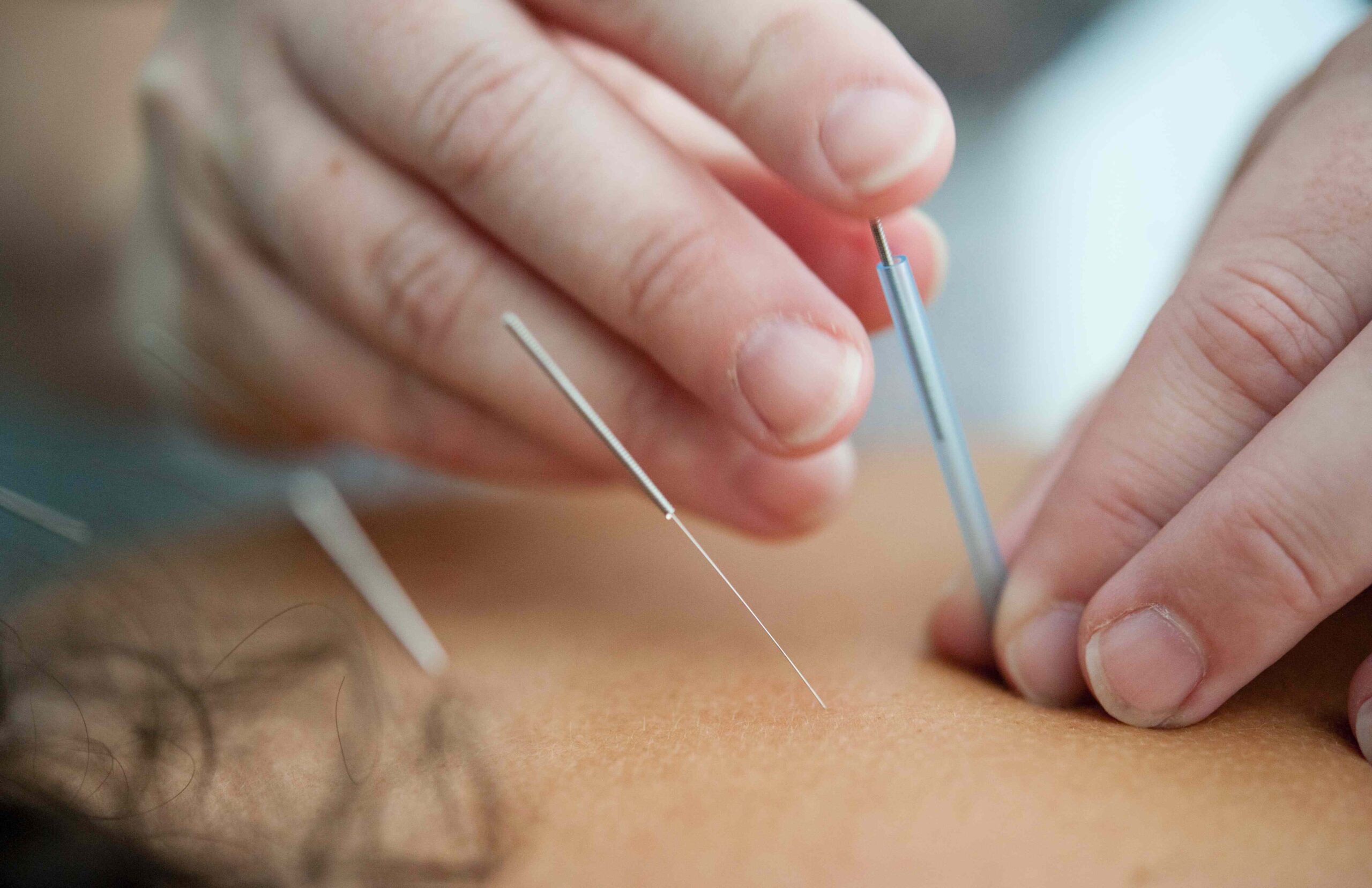 Acupuncture Treatment in High Wycombe