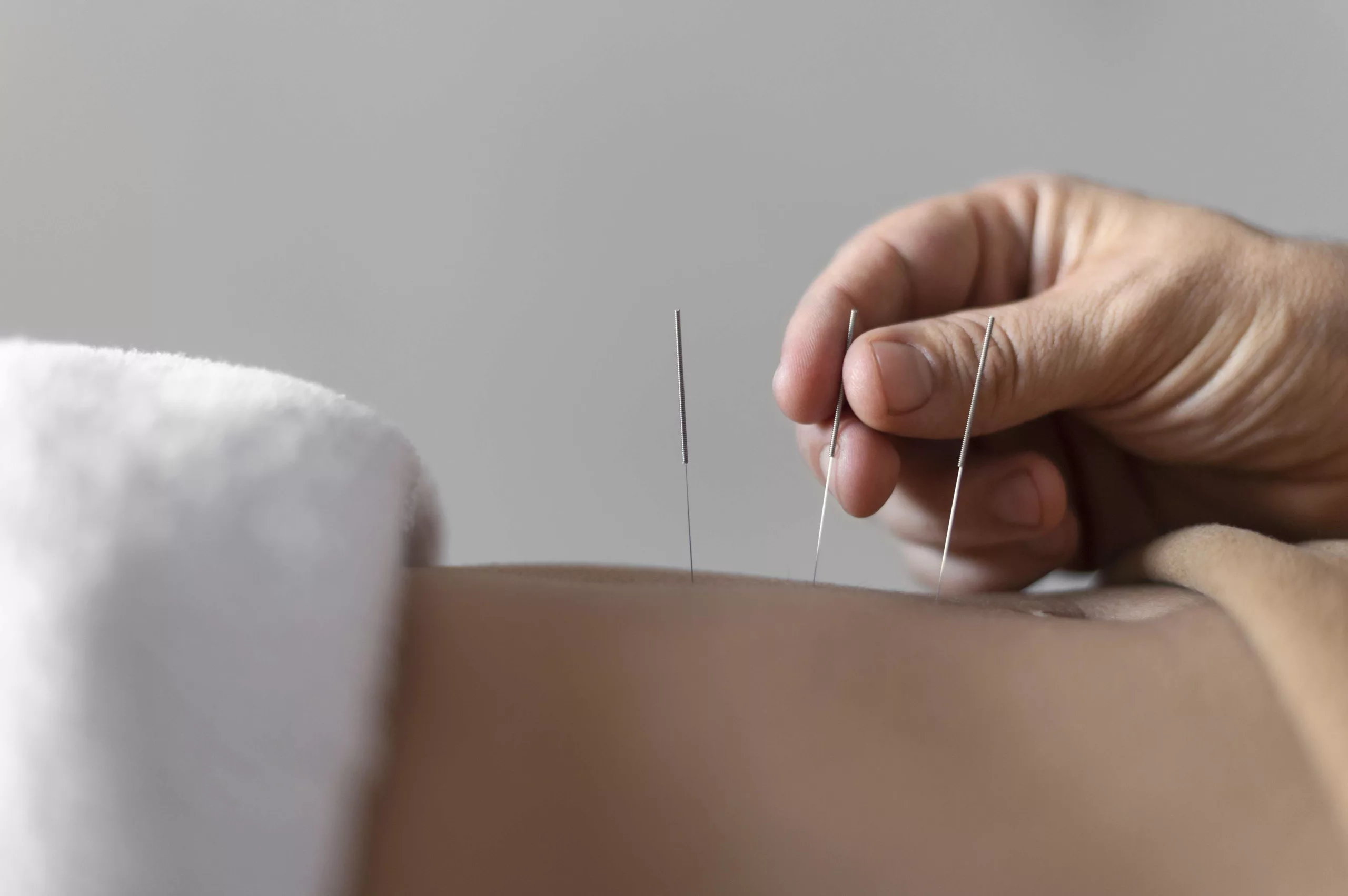 Acupuncture Treatment in Buckingham
