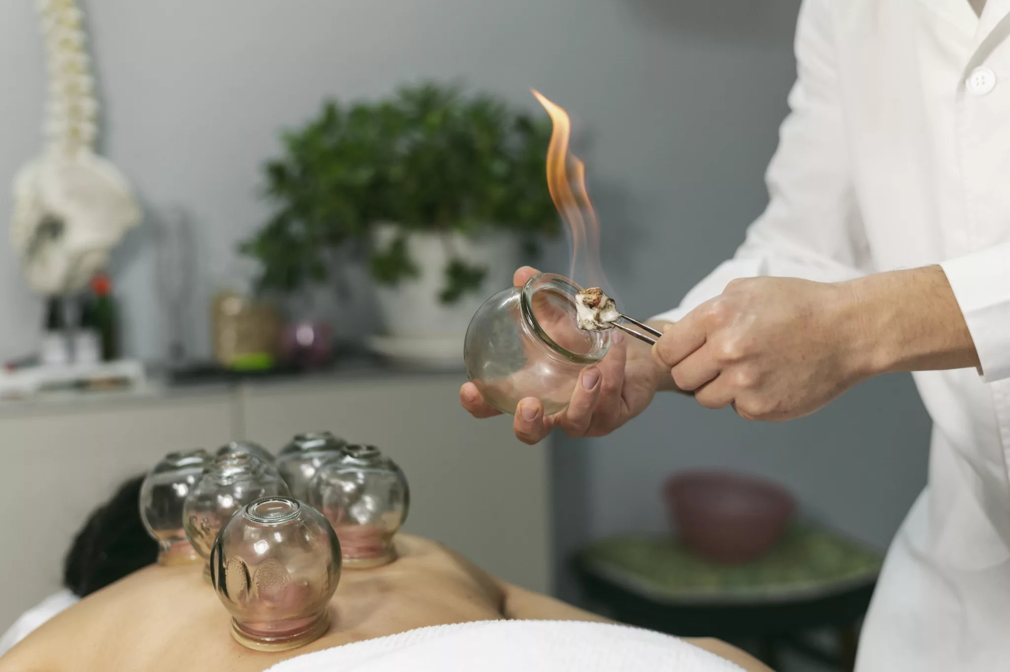 Cupping Therapy in Buckingham