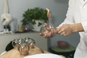 Cupping Therapy in Buckingham