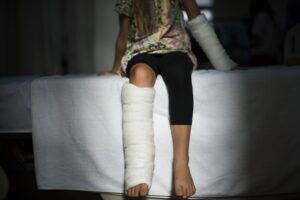 child broken leg