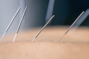 acupuncture for scar