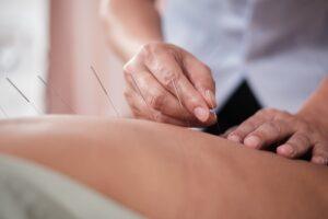 Acupuncture Therapist