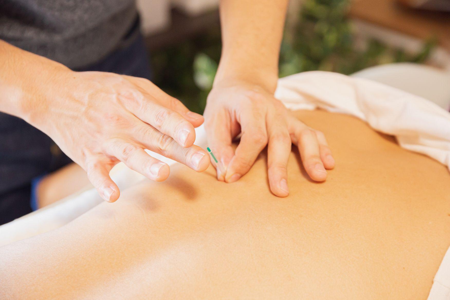 Acupuncture Session